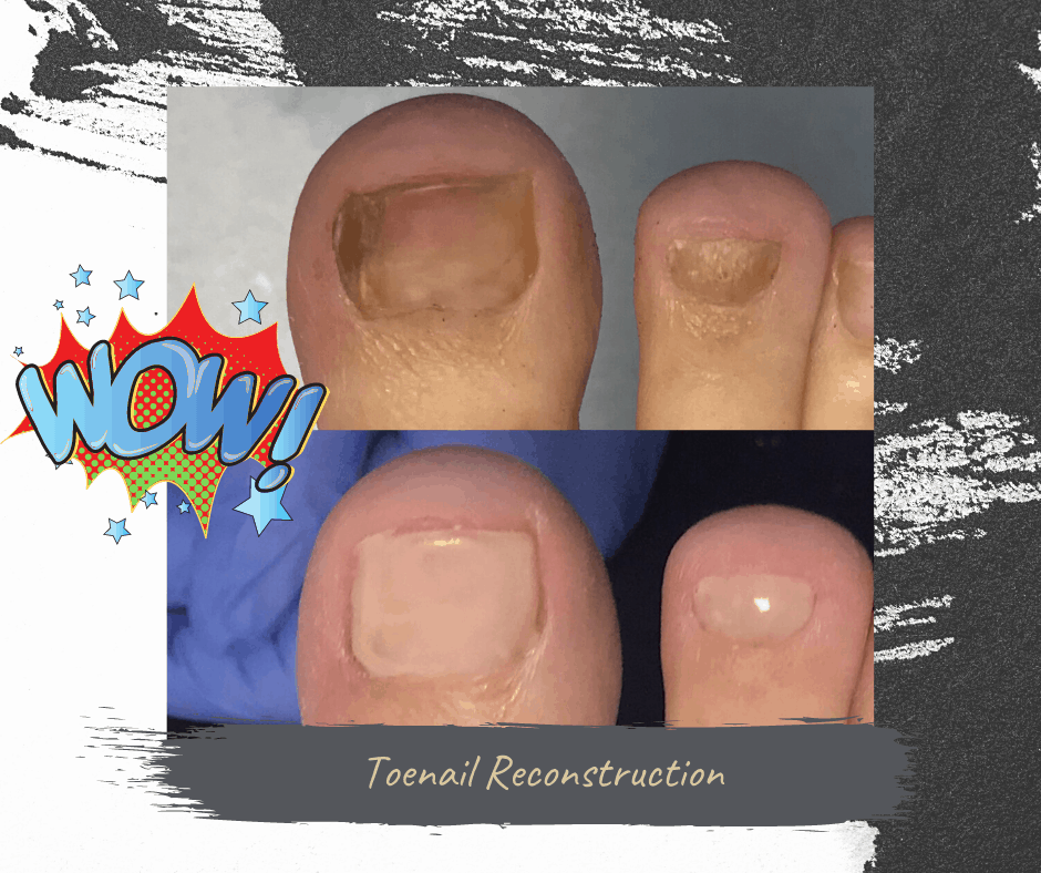 Toenail Reconstruction is the answer for damaged toenails - Walk This Way  Podiatry