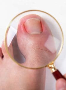 Image of a painful ingrown toenail