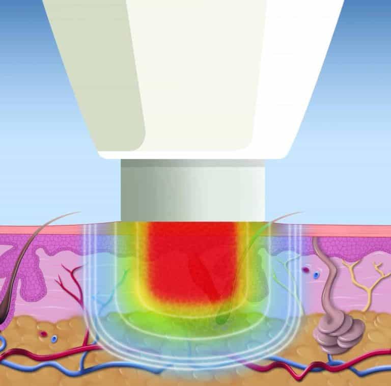 SWIFT Verruca Microwave Therapy