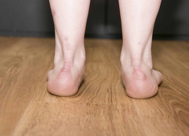 Flat Feet - Walk This Way Podiatry